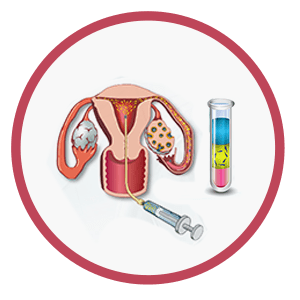 Intrauterine-insemination-(IUI)